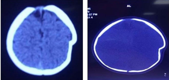 Hình ảnh lún sọ não trước mổ. Ảnh: BSCC.