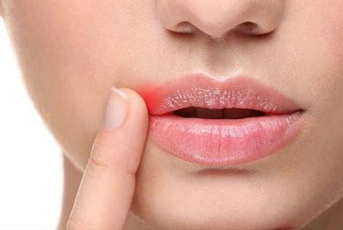 Virus bệnh tình dục gây ra những vết rộp, lở trên miệng có thể được ngăn ngừa bằng một loại thuốc trị bệnh thận - (ảnh minh họa từ internet)