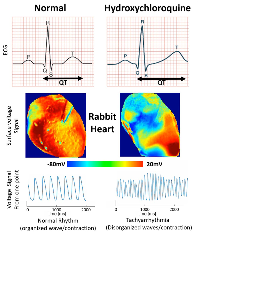 Hình ảnh cho thấy bề mặt điện áp trên tim thỏ không có HCQ là bình thường, kích hoạt điện lan truyền đồng nhất; trong khi với HCQ, sóng lan truyền không đều, tạo ra các mô hình phức tạp và rối loạn nhịp tim.