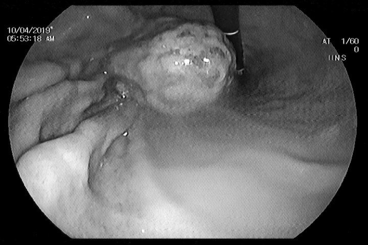 Hình ảnh nội soi khối bã trong dạ dày bệnh nhân. (Ảnh: BVCC)