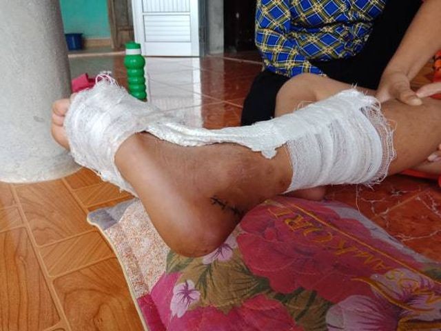 Học sinh bị đứt 2/3 gót chân trái nhưng Hiệu trưởng Trường Tiểu học Tân Ninh nói "bình thường".