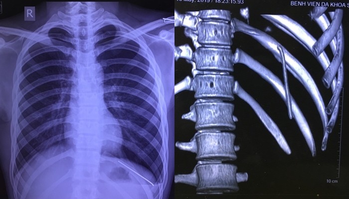 Hình ảnh chiếc đinh trong khoang phổi nam bệnh nhân. (Ảnh: BVCC)