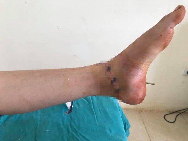 Bàn chân của bệnh nhân sau khi được nối lại.