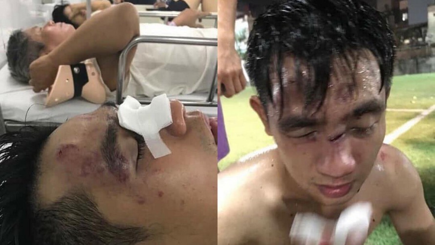 Do bị đánh hội đồng nên một thành viên trong đội bóng bị hại bị thương nặng phải nhập viện cấp cứu.