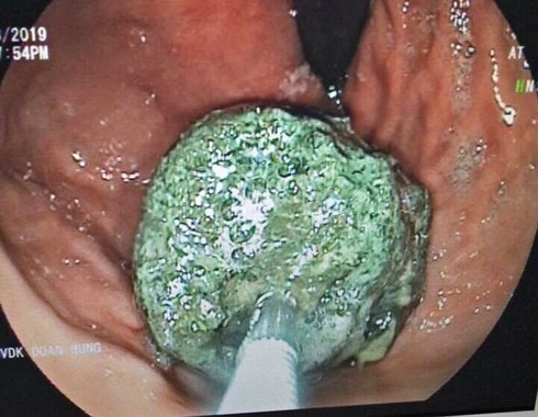 Hình ảnh siêu âm dạ dày của bệnh nhân