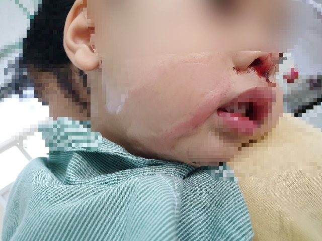 Bé trai bị bỏng nặng do mẹ nhỏ nhầm axit vào mũi. 