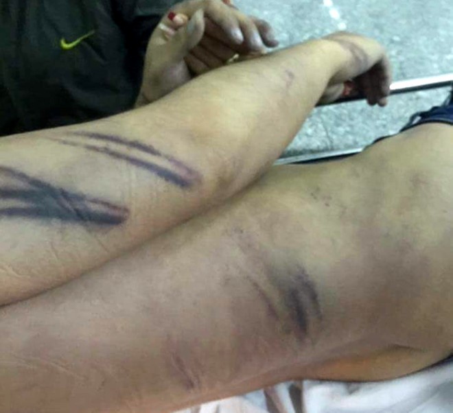 Hình ảnh những vết thương của bị can Minh được gia đình đưa lên mạng xã hội.