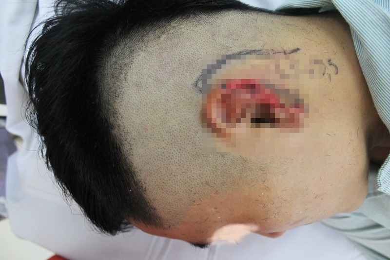 Một người đàn ông đã phải nhập viện tái tạo vành tai vì bị cắn nham nhở vành tai trái khi nhậu với bạn