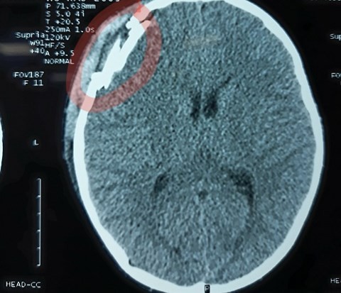 Hình ảnh chụp CT Scanner cho thấy sọ não cháu Điệp bị tổn thương nặng.