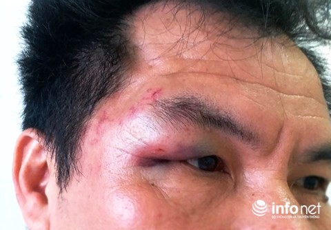 Vùng thái dương, mắt phải của PV Trần Cường bị đánh bầm tím, sưng húp. (Ảnh. NVCC)