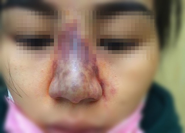 Tiêm filler làm đầy mũi khiến bệnh nhân bị tắc mạch, nguy cơ hỏng mắt (ảnh minh họa: internet)