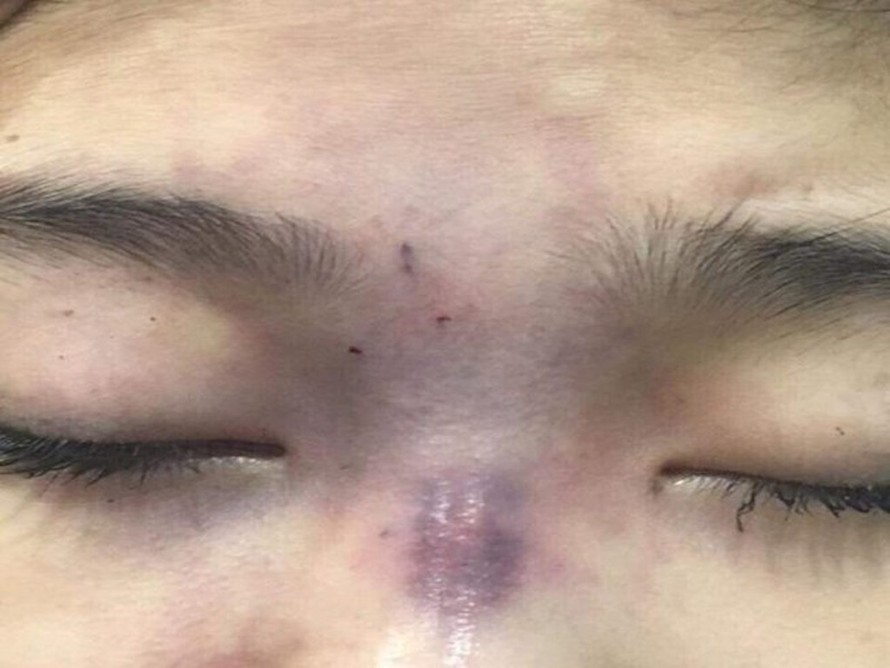 Cô gái 18 tuổi bị mù mắt do tiêm filler