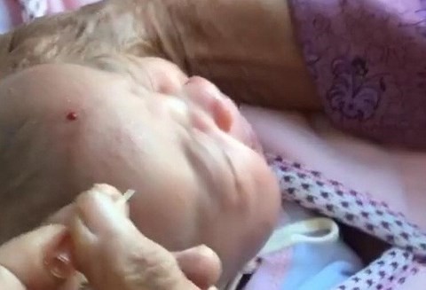 Hình ảnh một em bé làm lễ chích đẹn được chia sẻ trên mạng xã hội. 