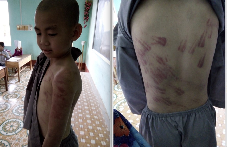 Hình ảnh các vết thương tích trên cơ thể cháu Dĩnh do cô giáo chủ nhiệm (Ảnh do cô Phạm Thị Nhuần cung cấp cho PV)