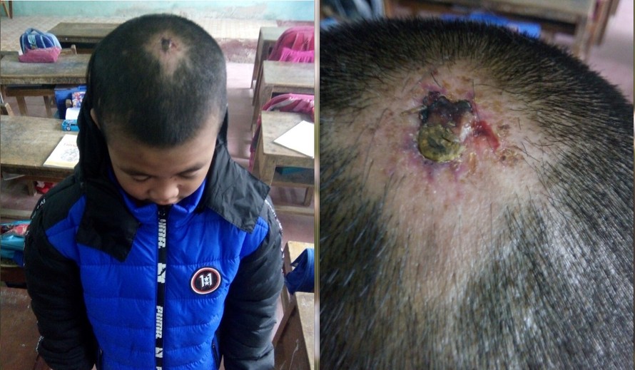 Hình ảnh thương tích trên đầu em Dĩnh do cô Nhuần chụp vào ngày 20/10/2018 (Ảnh do cô Phạm Thị Nhuần cung cấp cho PV)