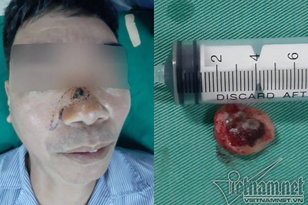 Hình ảnh nốt ruồi trên mũi ông Thanh khi đến khám (ảnh trái) và hình ảnh nốt ruồi được cắt bỏ sau phẫu thuật