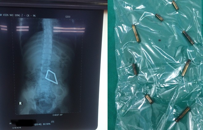 Các thanh nam châm trong ruột bệnh nhi trên phim X-quang (trái) và được lấy ra ngoài Ảnh: BVCC