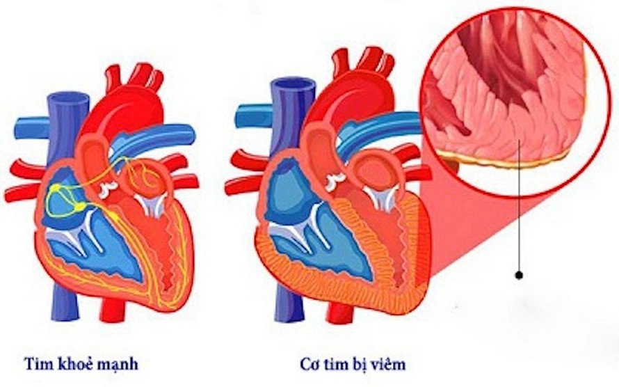 COVID-19 có thể ảnh hưởng đến tim.