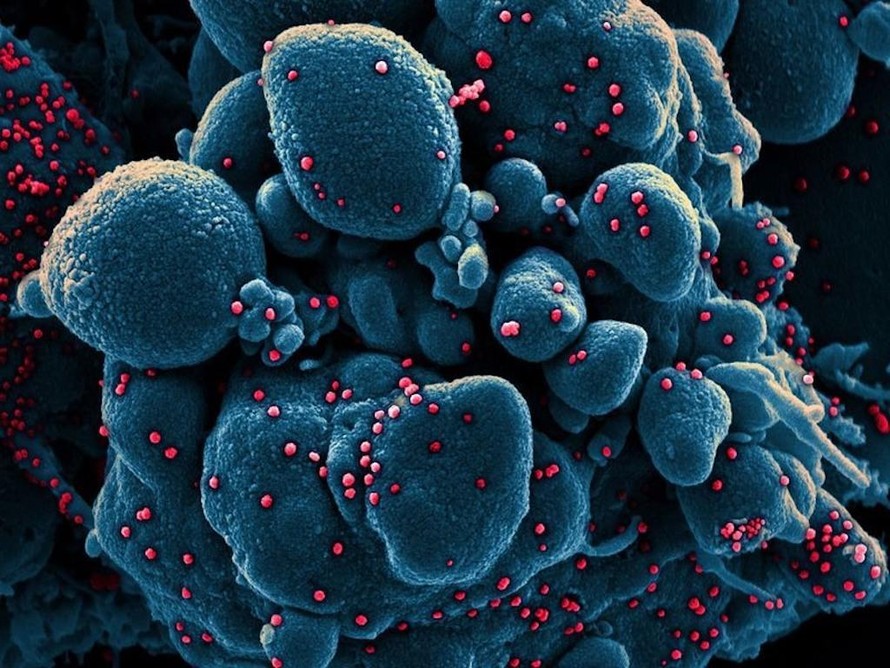 Bức ảnh về một tế bào sắp chết bị nhiễm SARS-CoV-2, với các hạt virus có màu đỏ.
