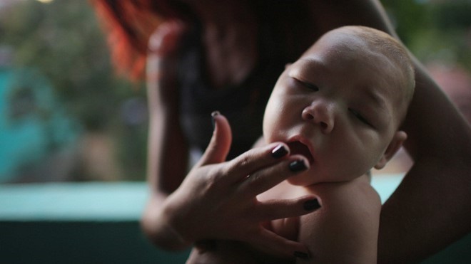 Virus Zika được xem là có mối liên quan với chứng não nhỏ ở trẻ sơ sinh. Ảnh: CNN.