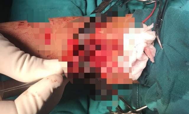 Các bác sĩ tiến hành vi phẫu nối động mạch cánh tay trái cho bé - Ảnh: Người Đưa Tin