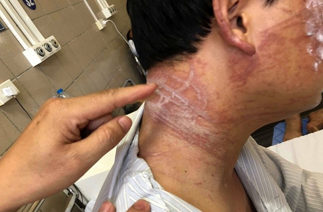 Tổn thương chằng chịt trên cổ, mặt, lưng của bệnh nhân sau 10 ngày bị sứa đốt. Ảnh: P.T.