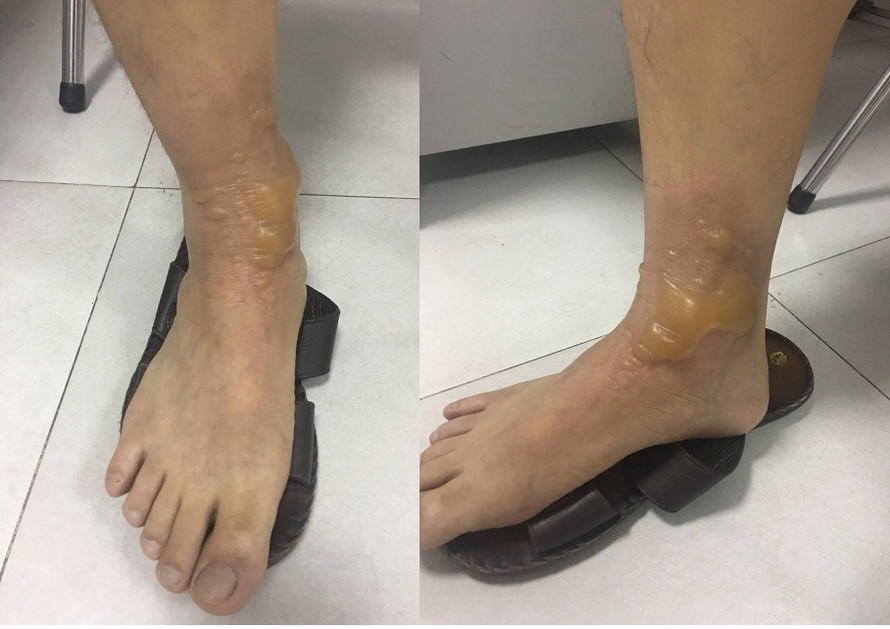 Vết bỏng ở chân bệnh nhân sau khi đi mát xa.