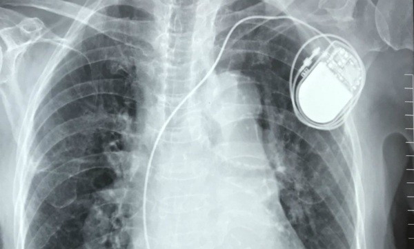Chiếc máy tạo nhịp tim đặt trong cơ thể cụ bà - Ảnh: Vnexpress
