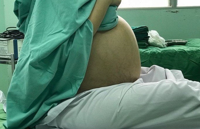 Phần bụng nữ bệnh nhân to khổng lồ vì khối u buồng trứng.