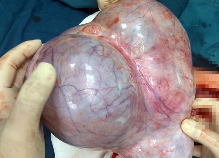 Khối u nang buồng trứng "khủng" được lấy ra từ trong bụng bệnh nhân.