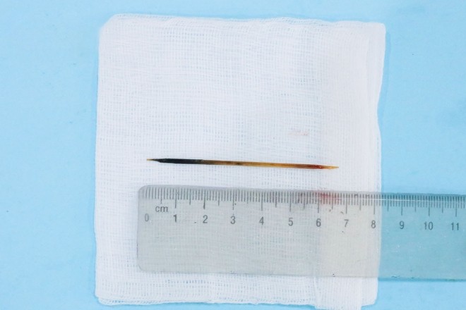 hiếc tăm dài khoảng 7cm được lấy ra từ bụng bệnh nhân - Ảnh: Báo Người đưa tin