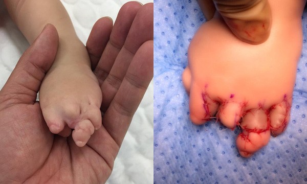 Hình ảnh các ngón tay của bệnh nhi trước và sau can thiệp - Ảnh: VTV