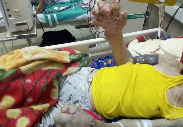 Bàn tay bệnh nhân bị biến dạng khớp - Ảnh: VietNamNet