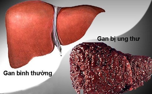 Ung thư gan là bệnh ung thư chiếm số 1 ở Việt Nam
