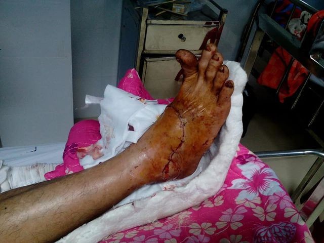 Bàn chân phải của bệnh nhân đã có dấu hiệu hồi phục - Ảnh: Dân Trí