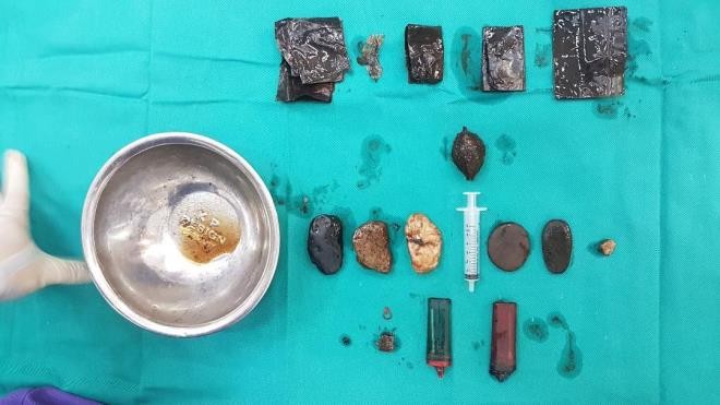 Dị vật là đá, sỏi, bật lửa, túi nilon được lấy ra khỏi dạ dày bệnh nhân 55 tuổi - Ảnh: VTC News