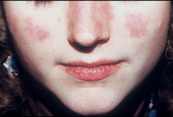 Lupus ban đỏ - căn bệnh nguy hiểm chết người ít được biết đến