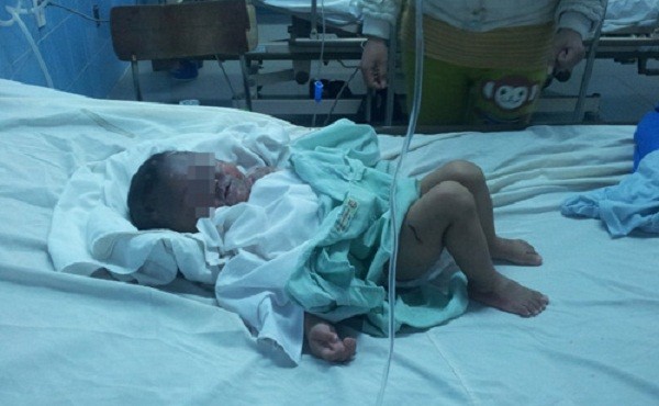 Bé trai 13 tháng bị bỏng toàn thân do ngã vào chai xăng