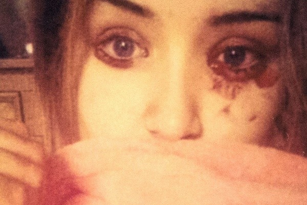 Mắc bệnh lạ cô gái chảy máu mắt 5 lần một ngày
