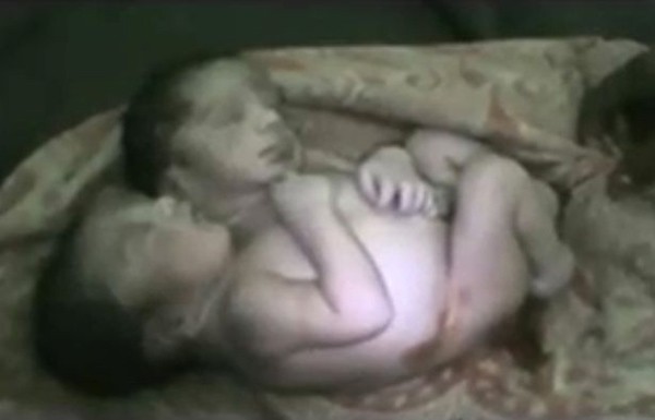 Xót xa số phận ngắn ngủi của bé sơ sinh hai đầu ở Ấn Độ