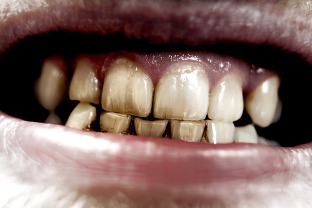 Những điều đơn giản bạn phải biết để tự bảo vệ răng miệng