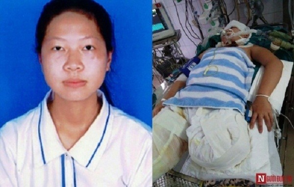 Xót xa thiếu nữ bị mất cả hai chân vì lao vào cứu cha cháy đen