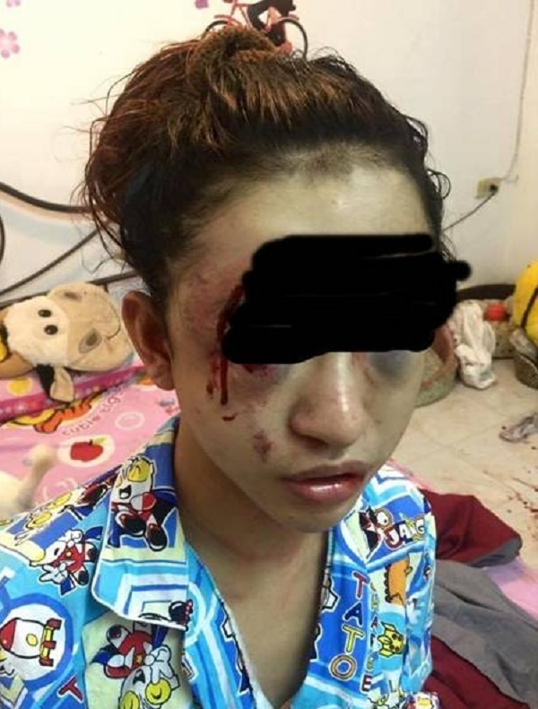 Vì bát cẩn cô gái bị trộm lẻn vào đánh 'nát' khuôn mặt 