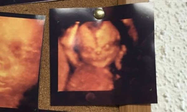 Lý giải những bức ảnh siêu âm thai nhi kì quái gây xôn xao