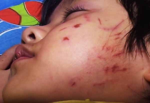 Bé 4 tuổi bị bạn cào rách mặt: 'Cần dạy trẻ ứng phó với bắt nạt'