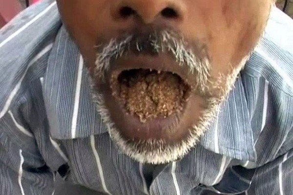 Kì lạ người đàn ông có sở thích ăn cát sỏi suốt 25 năm