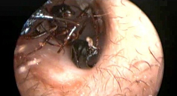Kinh hoàng phát hiện hàng nghìn con kiến trong tai cô bé 12 tuổi
