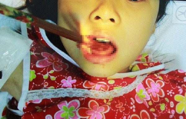 Đang ăn, bé gái bị đũa đâm thủng lưỡi