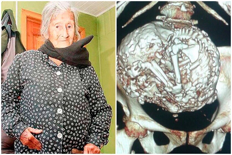 60 năm thai nhi nằm trong bụng bà cụ 91 tuổi mà không biết