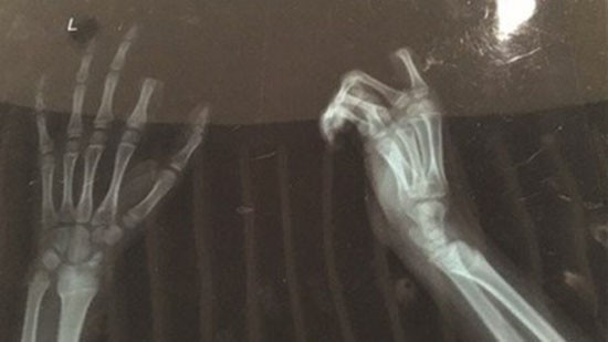 Bé trai tự cắt đứt ngón tay vì bị mắng dùng smartphone nhiều
